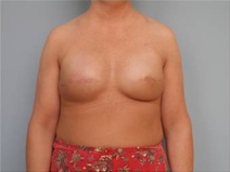 Breast Reconstruction After Photo by Richard Wassermann, MD, MPH, FACS; Columbia, SC - Case 22074