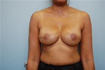 Breast Reconstruction After Photo by Richard Wassermann, MD, MPH, FACS; Columbia, SC - Case 22250