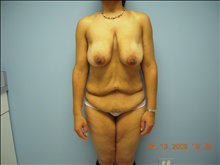 Body Contouring Before Photo by Florence Mussat, MD; ,  - Case 24745