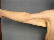 Arm Lift After Photo by Ellen Janetzke, MD; ,  - Case 25137