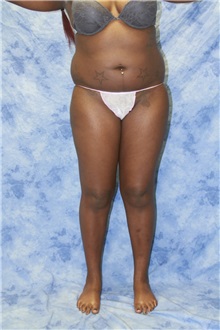 Liposuction Before Photo by Wendell Perry, MD; Alexandria, VA - Case 27774