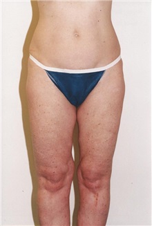 Liposuction Before Photo by Kristoffer Ning Chang, MD; ,  - Case 28247