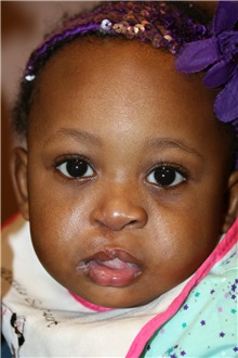 Cleft Lip and Palate Repair After Photo by Joseph Mlakar, MD, FACS; ,  - Case 29495