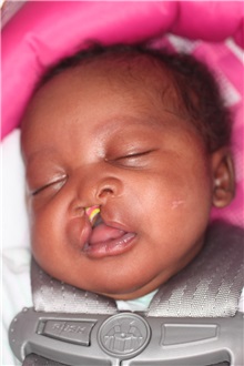 Cleft Lip and Palate Repair Before Photo by Joseph Mlakar, MD, FACS; ,  - Case 29495