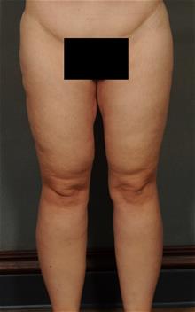 Thigh Lift After Photo by Ellen Janetzke, MD; ,  - Case 29770