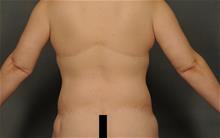 Body Lift After Photo by Ellen Janetzke, MD; ,  - Case 29803