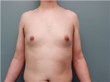 Male Breast Reduction Before Photo by Larry Nichter, MD; ,  - Case 29831