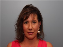 Facelift After Photo by Larry Nichter, MD; ,  - Case 29837