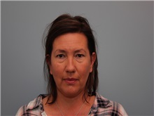 Facelift Before Photo by Larry Nichter, MD; ,  - Case 29837