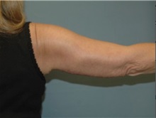 Arm Lift After Photo by Larry Nichter, MD; ,  - Case 29854