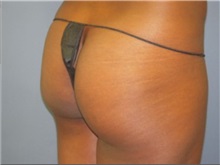 Buttock Lift with Augmentation Before Photo by Larry Nichter, MD; ,  - Case 29855