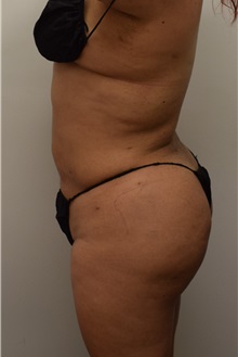 Buttock Lift with Augmentation After Photo by Meegan Gruber, MD, PhD; Tampa, FL - Case 29921