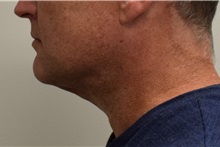 Liposuction After Photo by Meegan Gruber, MD, PhD; Tampa, FL - Case 29924