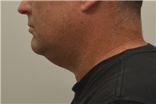 Liposuction Before Photo by Meegan Gruber, MD, PhD; Tampa, FL - Case 29924