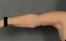 Arm Lift After Photo by Ellen Janetzke, MD; ,  - Case 29963