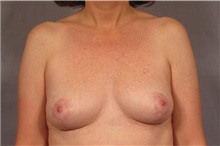 Breast Implant Removal After Photo by Kent Hasen, MD; Naples, FL - Case 30694