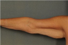Arm Lift Before Photo by Ellen Janetzke, MD; ,  - Case 30788