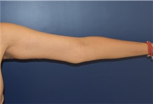Arm Lift After Photo by Richard Reish, MD, FACS; New York, NY - Case 30791