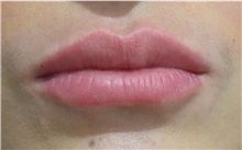 Lip Augmentation/Enhancement After Photo by Richard Reish, MD, FACS; New York, NY - Case 30833