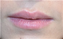 Lip Augmentation/Enhancement Before Photo by Richard Reish, MD, FACS; New York, NY - Case 30833