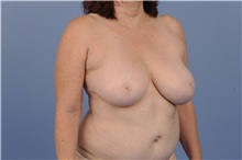 Breast Reduction Before Photo by Trent Douglas, MD; Knoxville, TN - Case 31410
