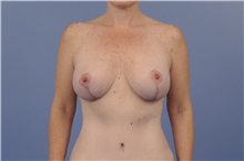Body Contouring After Photo by Trent Douglas, MD; Knoxville, TN - Case 31417