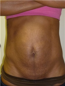 Liposuction Before Photo by Mark Markarian, MD, MSPH, FACS; Wellesley, MA - Case 31768