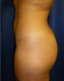 Buttock Lift with Augmentation Before Photo by Mark Markarian, MD, MSPH, FACS; Wellesley, MA - Case 31809