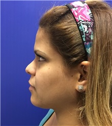 Dermal Fillers Before Photo by Mark Markarian, MD, MSPH, FACS; Wellesley, MA - Case 31840