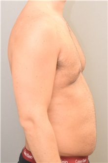 Male Breast Reduction Before Photo by Keshav Magge, MD; Bethesda, MD - Case 32232