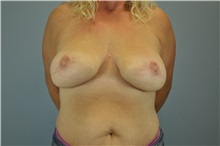 Breast Reconstruction After Photo by Paul Vanek, MD, FACS; Concord, OH - Case 32800