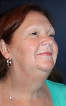 Facelift Before Photo by Larry Weinstein, MD; Chester, NJ - Case 33155