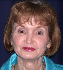 Facelift After Photo by Gary Culbertson, MD, FACS; ,  - Case 33347