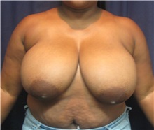 Breast Reduction Before Photo by Gary Culbertson, MD, FACS; ,  - Case 33460