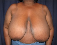 Breast Reduction Before Photo by Gary Culbertson, MD, FACS; ,  - Case 33476