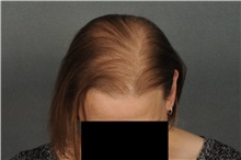 Hair Transplant After Photo by Ellen Janetzke, MD; ,  - Case 33899