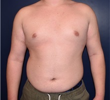 Male Breast Reduction After Photo by Rachel Ruotolo, MD; Garden City, NY - Case 34088