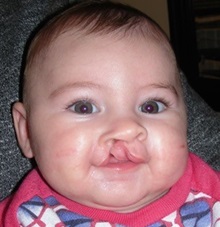 Cleft Lip and Palate Repair Before Photo by Rachel Ruotolo, MD; Garden City, NY - Case 34149