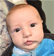 Cleft Lip and Palate Repair Before Photo by Rachel Ruotolo, MD; Garden City, NY - Case 34211