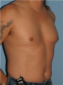 Male Breast Reduction Before Photo by Paul Vanek, MD, FACS; Concord, OH - Case 34235