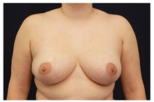 Breast Reduction After Photo by Michael Law, MD; Raleigh, NC - Case 34244