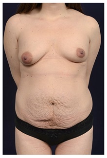 Body Contouring Before Photo by Michael Law, MD; Raleigh, NC - Case 34263