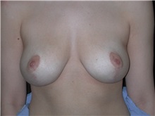 Breast Reduction After Photo by Frederick Lukash, MD, FACS, FAAP; North Hills, NY - Case 35150