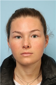 Rhinoplasty After Photo by Robert Zubowski, MD; ,  - Case 35234