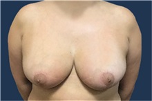 Breast Reduction After Photo by Brian Pinsky, MD, FACS; Babylon, NY - Case 35485