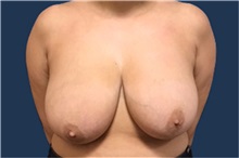 Breast Reduction Before Photo by Brian Pinsky, MD, FACS; Babylon, NY - Case 35485