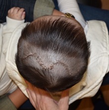 Craniosynostosis After Photo by Rachel Ruotolo, MD; Garden City, NY - Case 35528