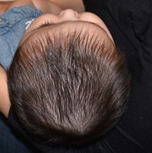 Craniosynostosis Before Photo by Rachel Ruotolo, MD; Garden City, NY - Case 35528