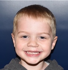 Cleft Lip and Palate Repair After Photo by Rachel Ruotolo, MD; Garden City, NY - Case 35530