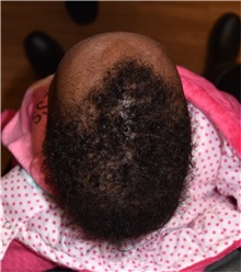 Craniosynostosis Before Photo by Rachel Ruotolo, MD; Garden City, NY - Case 35577